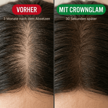CrownGlam - Du hast die Pille abgesetzt. Dein Haar braucht noch Zeit. Wir überbrücken sie.
